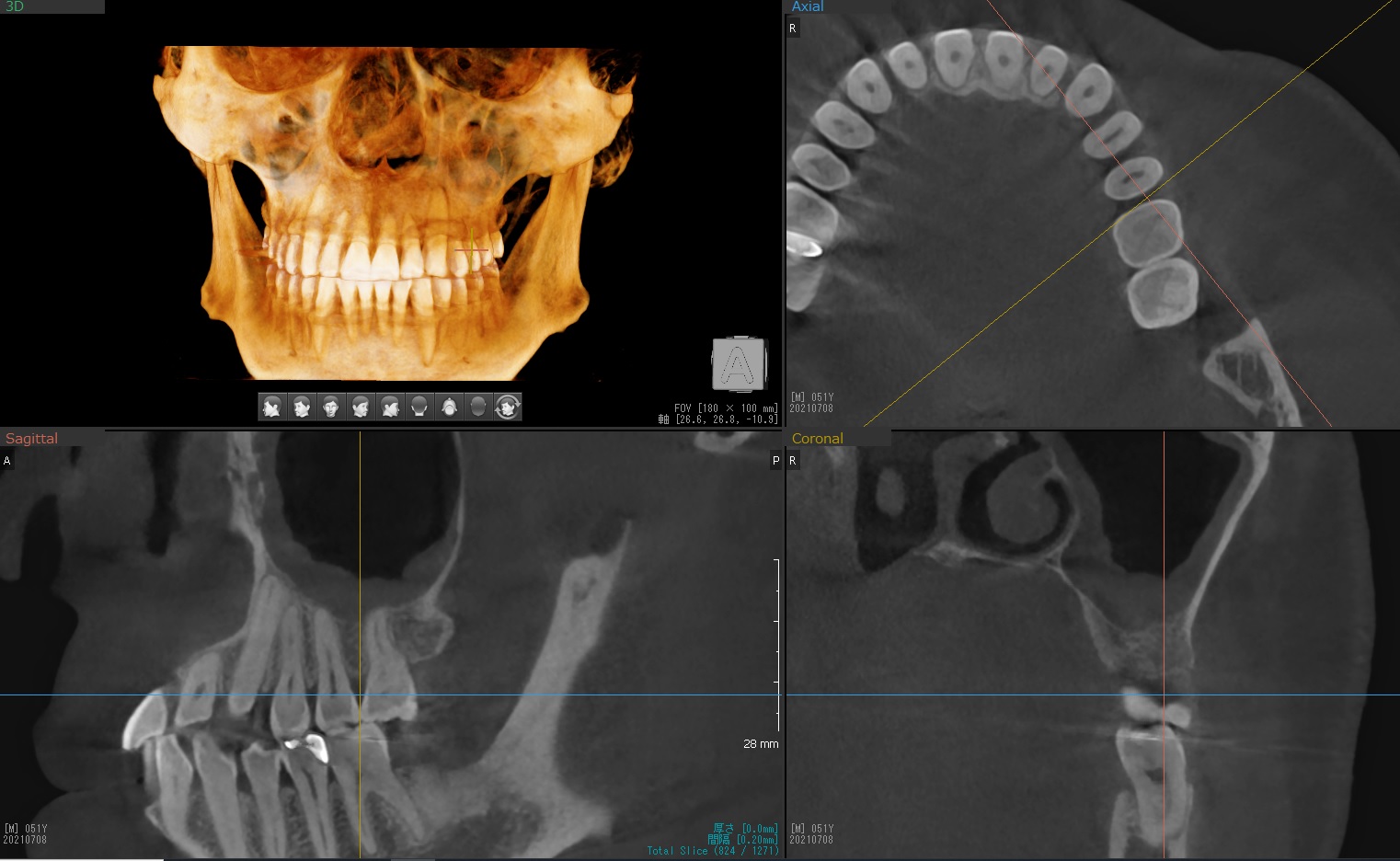 顎関節症　CTレントゲン　西小岩歯科クリニック